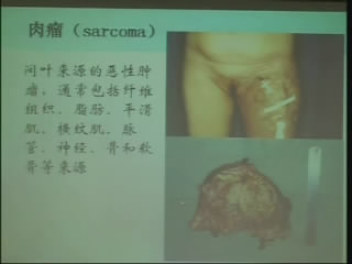 肿瘤学概论视频教程 32讲 复旦大学 精品课程
